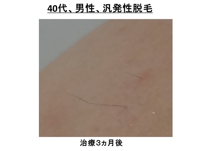 円形脱毛症　病院